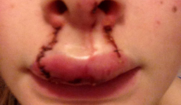 Cô gái 18 tuổi bị bạn trai cắn nát môi khi đang hôn